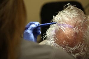 PRP being injected into a mans scalp for hair loss