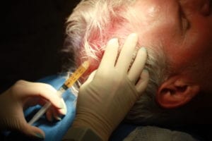 Needle being injected into patients scalp for hair loss treatment