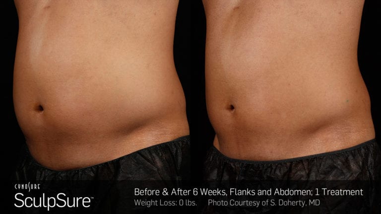 SculpSure after treatment