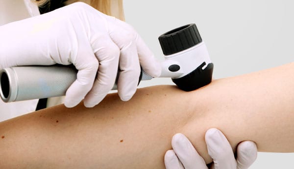 skin-cancer-2