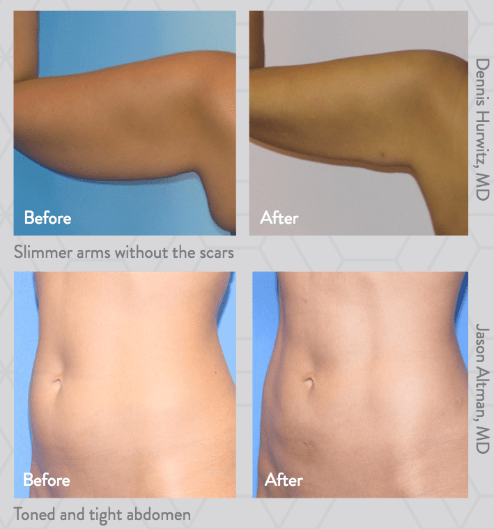 BodyTite Before and After image set of a womands arm and abdomen