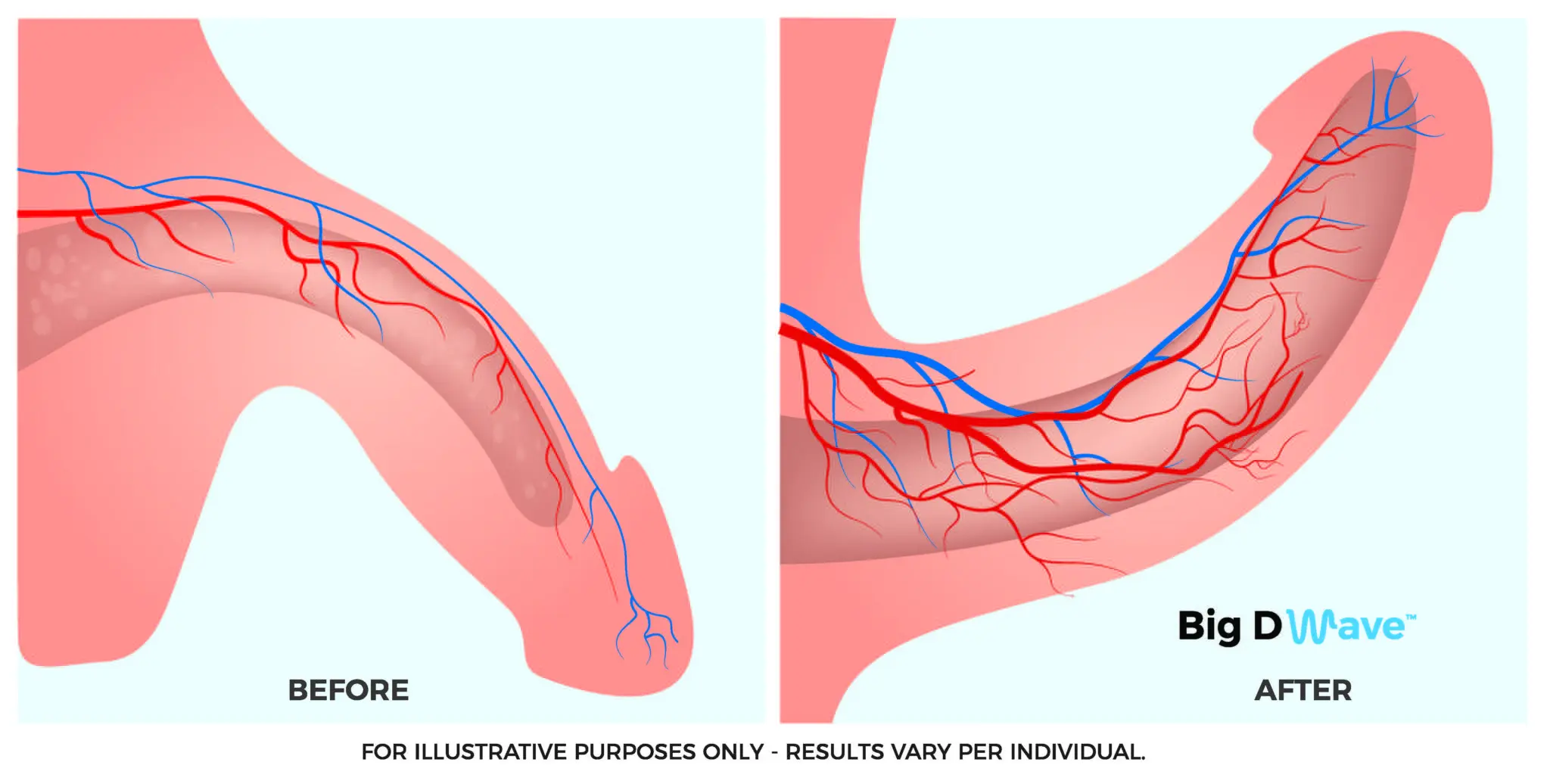 Big D Wave Therapy