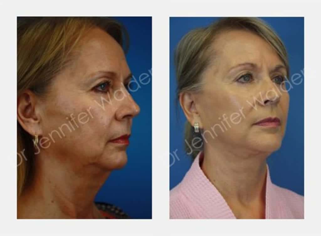 Skin Resurfacing Austin Venus Viva Simple Radiance Medspa