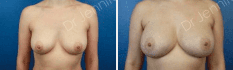 Fat Grafting | Fat Transfer Breast Augmentation in Austin TX | Dr. Walden