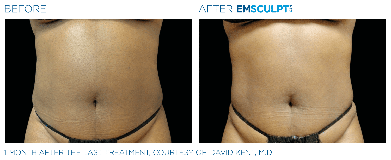 Emsculpt Neo PIC Ba Card Female Abdomen 005 ENUS100 1