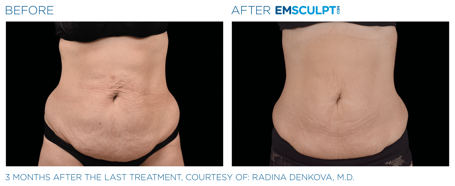Emsculpt Neo PIC Ba Card Female Abdomen 009 ENUS100 1