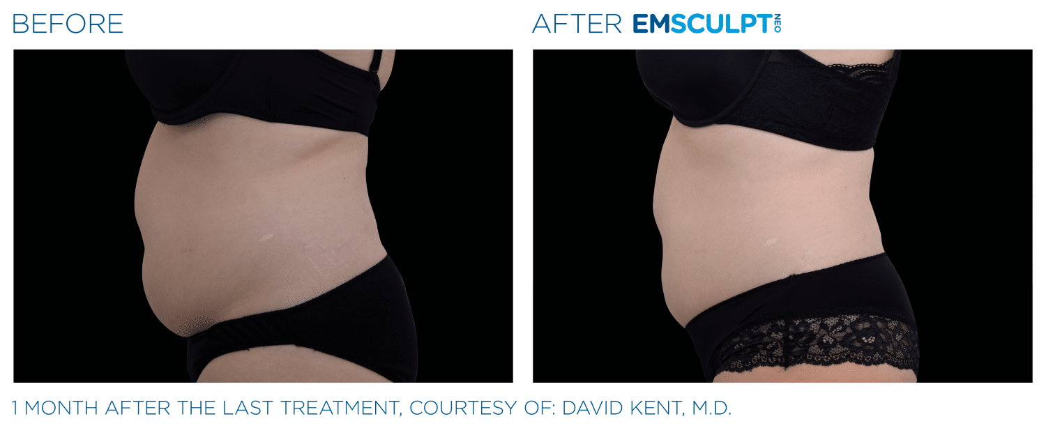 Emsculpt Neo PIC Ba Card Female Abdomen 020 ENUS100 Min 1