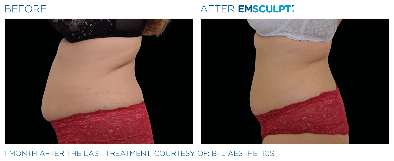 Emsculpt Neo PIC Ba Card Female Abdomen 025 ENUS100 1