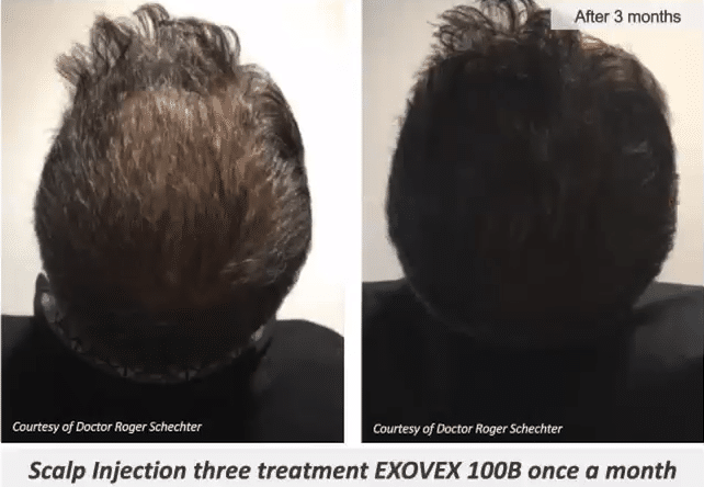 Evovex 1