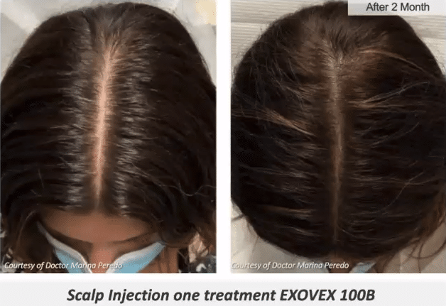 Evovex 2