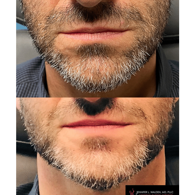 Before After Tear Trough Cheekbone Jawline And Chin Filler Voluma Karen Zizzo