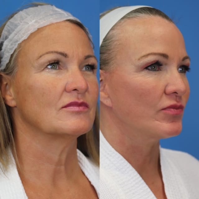 Before And After Surgical Face And Necklift Atencio 1