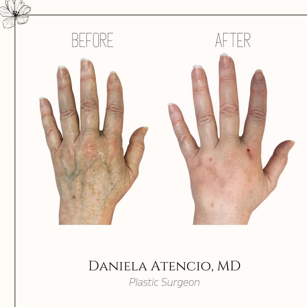 Before And After Hand Filler With Radiesse Atencio 1