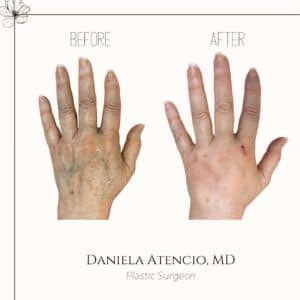 Before And After Hand Filler With Radiesse Atencio 300x300