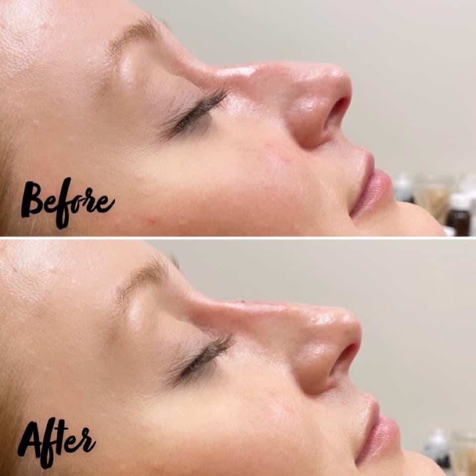 Nasal Filler Liquid Rhino Atencio 1