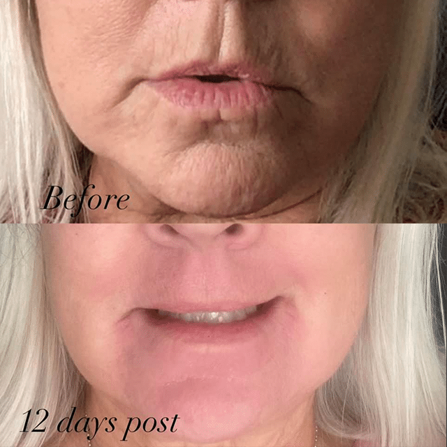 Before After Laser Resurfacing By Courtney Grant