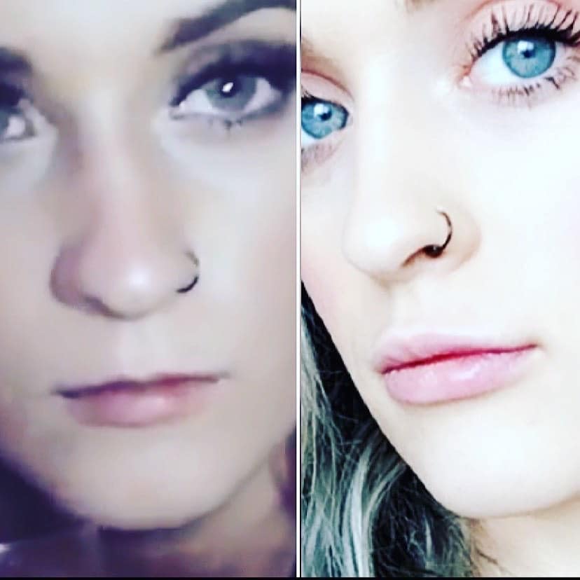 Lip Filler Karen Zizzo 1