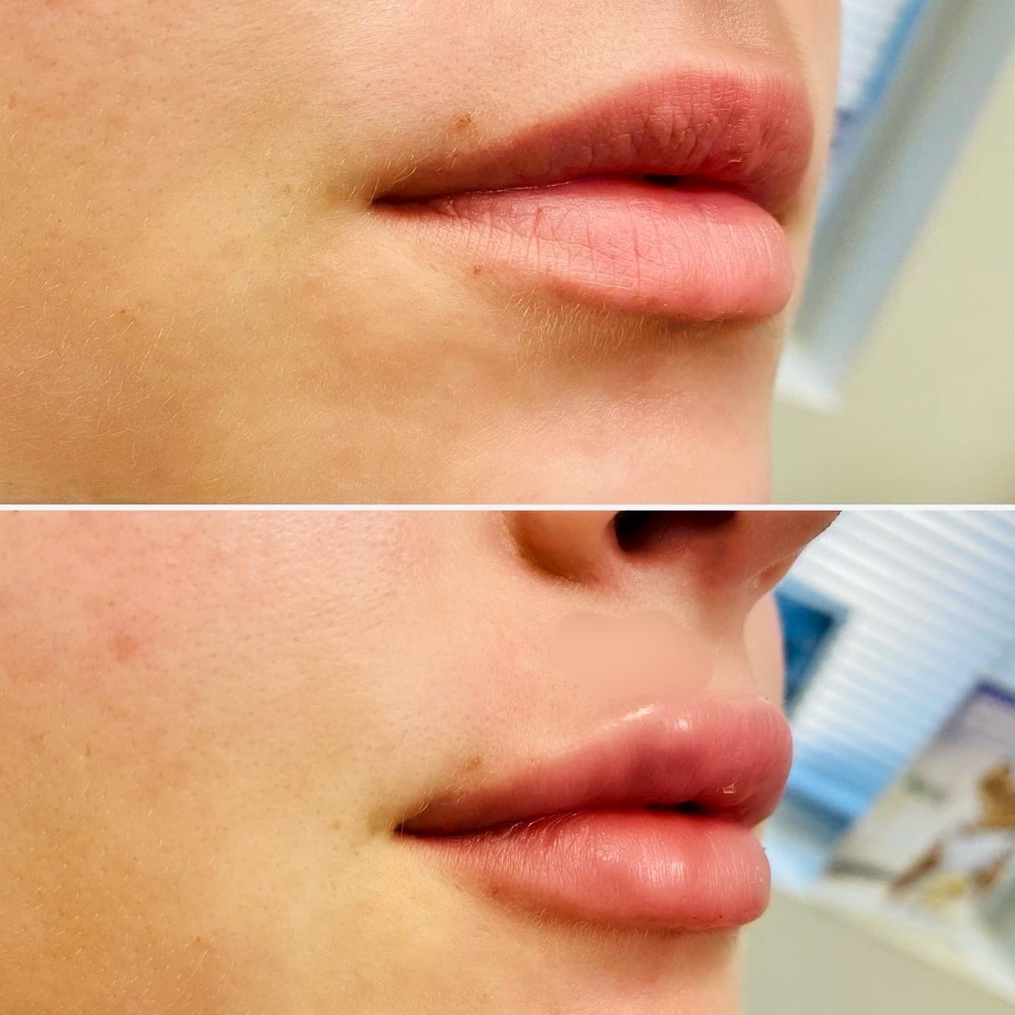 Lip Filler Atencio Vollure 1