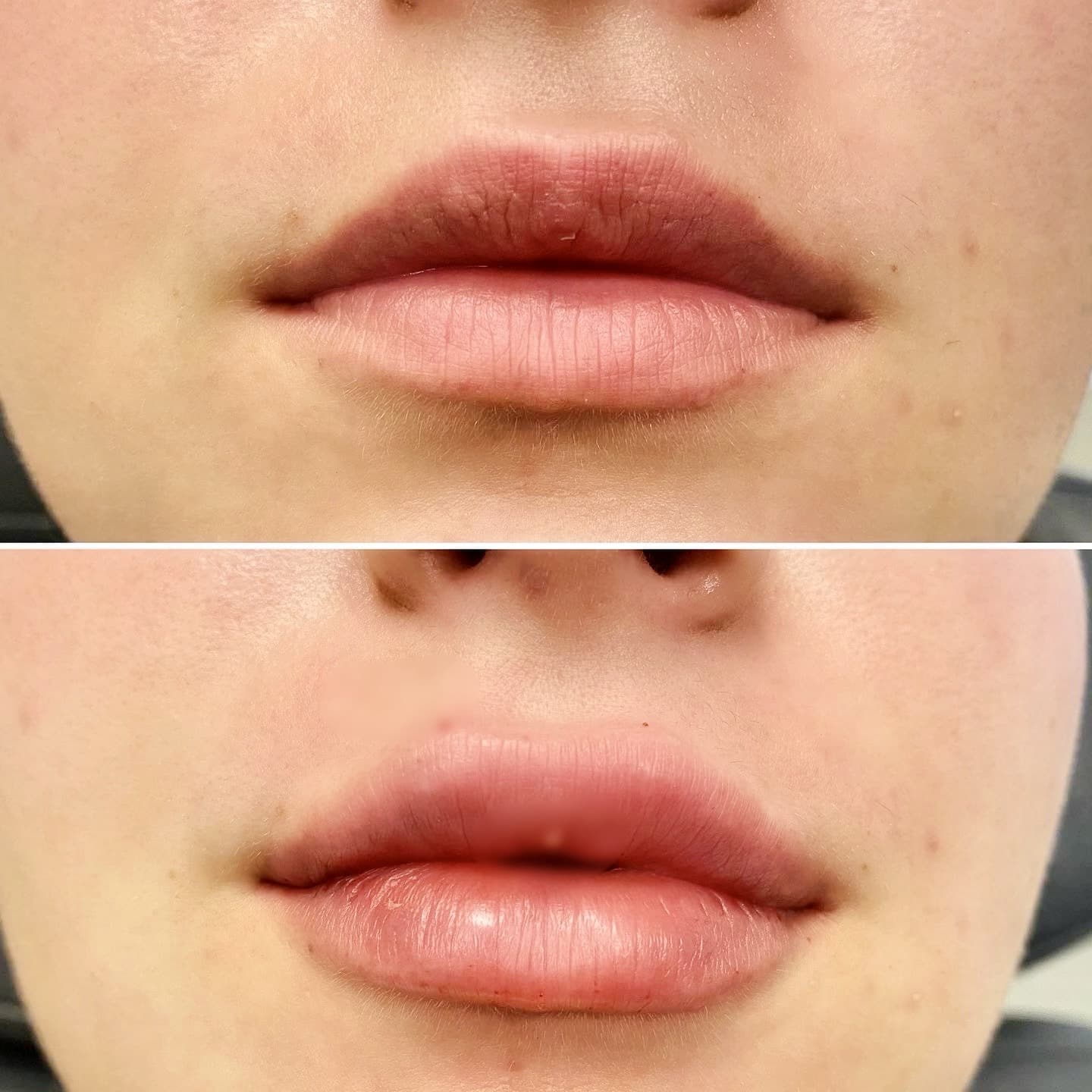 Lip Filler2 Atencio Vollure 1
