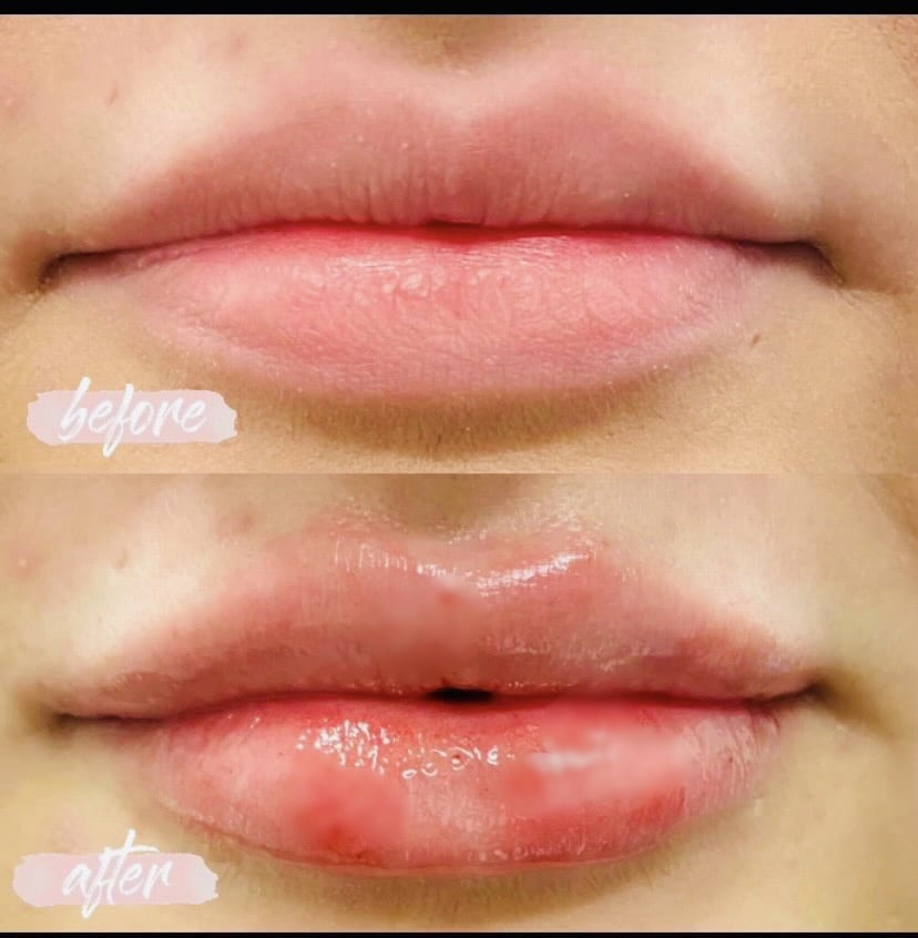 Lip Filler2 Zizzo 1