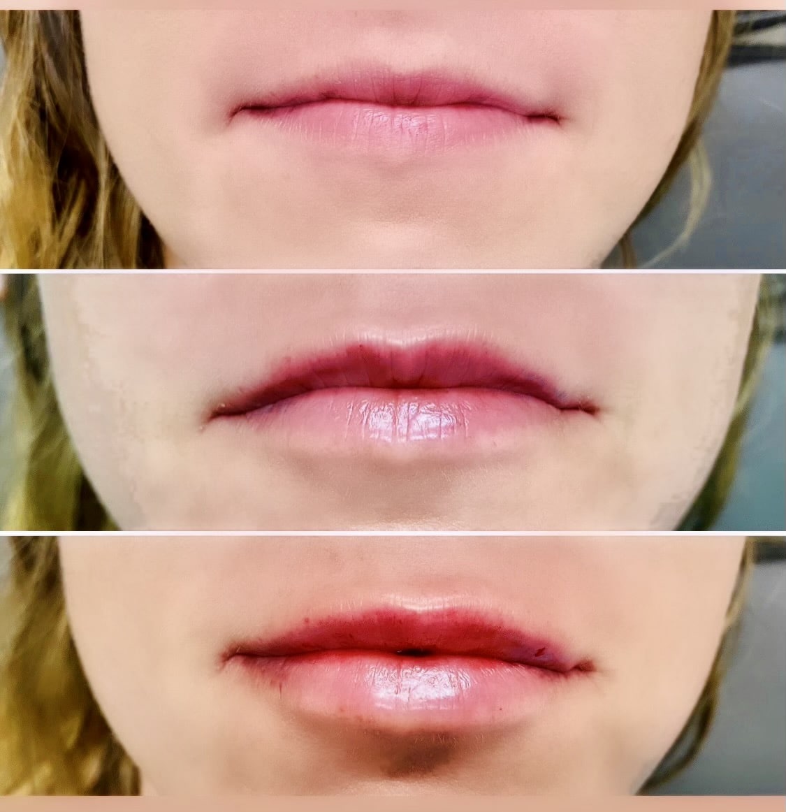 Lip Filler3 Atencio Kysse 1