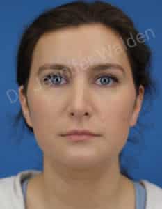 Septorhinoplasty