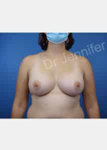 Breast Augmentation