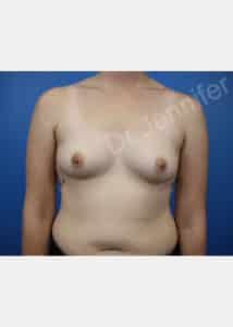 Breast Augmentation