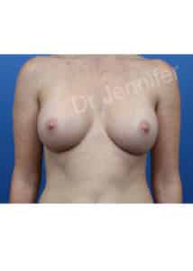 Breast Augmentation
