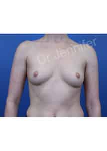 Breast Augmentation