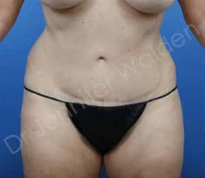 Abdominoplasty