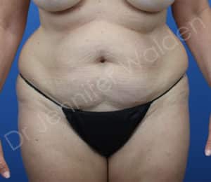 Abdominoplasty