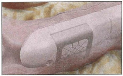 morpheus8v device inside vaginal canal