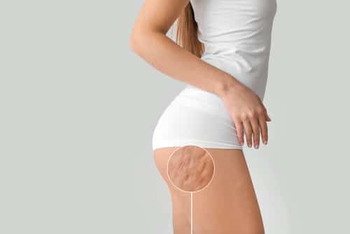 woman with cellulite problem on light background