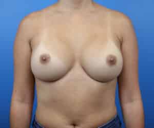 Breast Augmentation