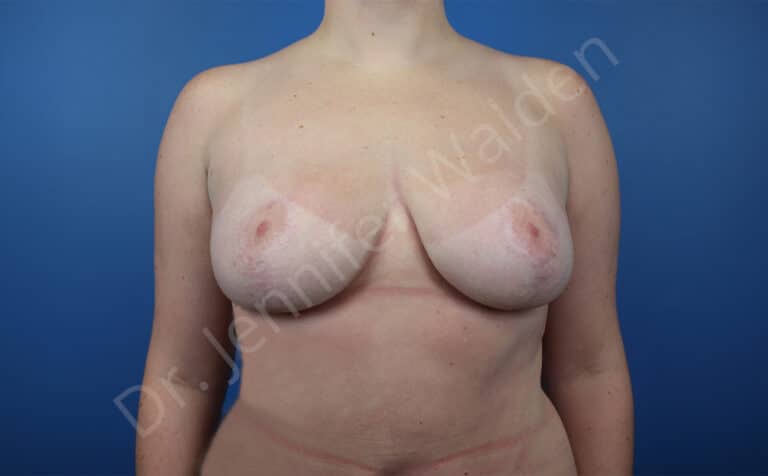 After Image: Breast Reduction - front