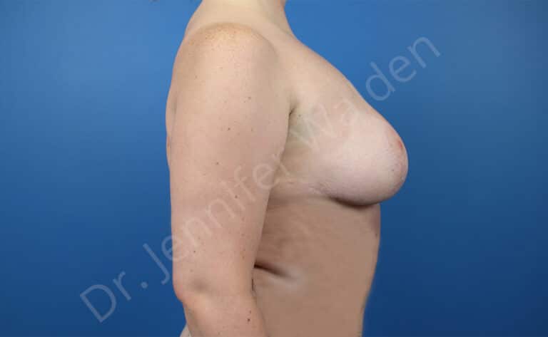After Image: Breast Reduction - right-side