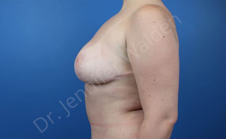 After Image: Breast Reduction - left-side