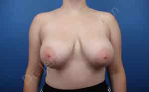 Breast Reduction