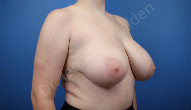 Before Image: Breast Reduction - right-front-oblique