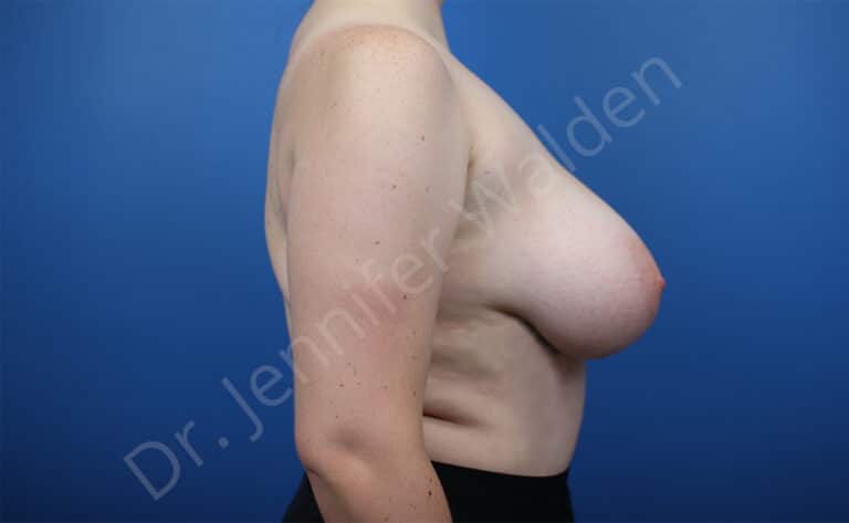 Before Image: Breast Reduction - right-side