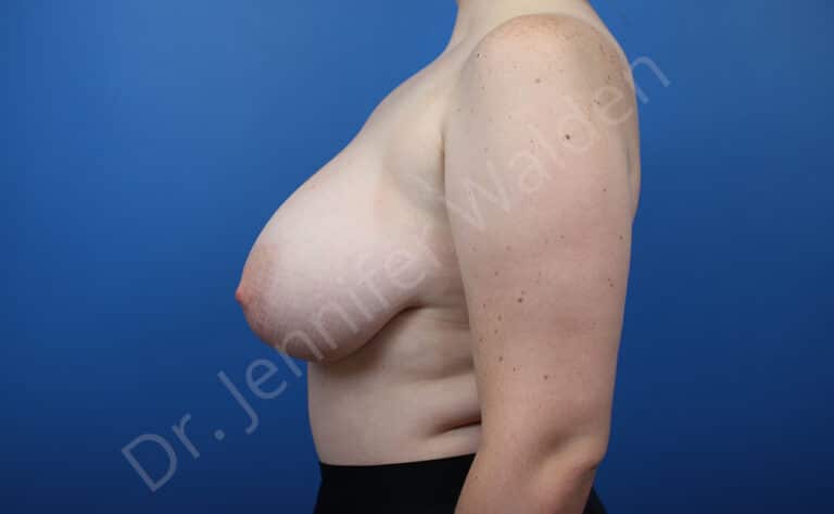 Before Image: Breast Reduction - left-side