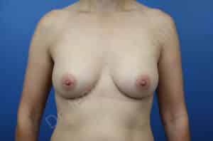 Breast Augmentation