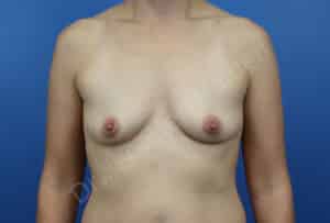 Breast Augmentation