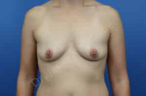 Breast Augmentation