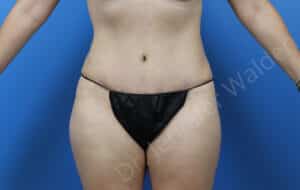 Abdominoplasty