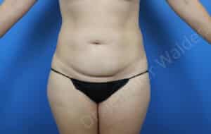 Abdominoplasty