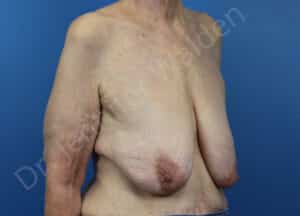 Breast Lift (Mastopexy)