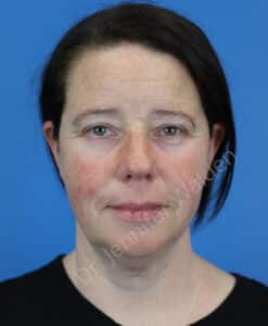 After Image: Blepharoplasty