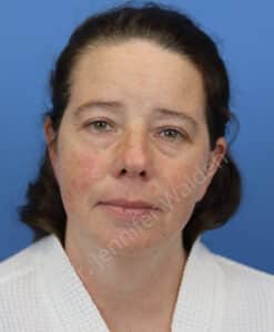 Before Image: Blepharoplasty